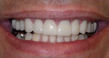 Gumdisease after | rapid city dentist used advanced technologies, lasers to prevent, reverse destructive symptoms of gum disease