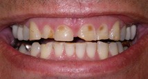 Gumdisease before | rapid city dentist used advanced technologies, lasers to prevent, reverse destructive symptoms of gum disease