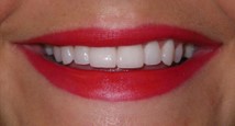 Post porcelain veneers