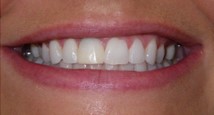 Before porcelain veneers