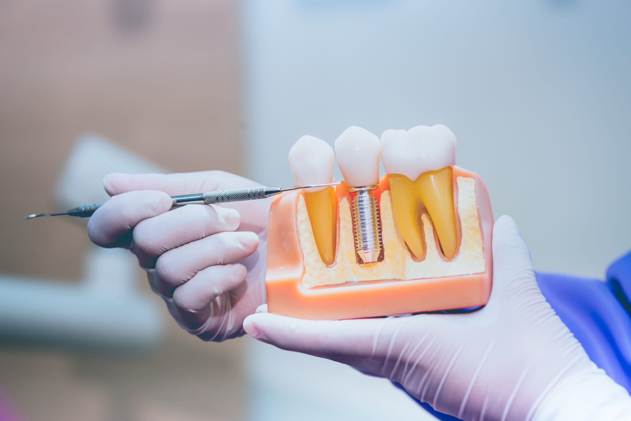 Dental implants from your dentist in rapid city