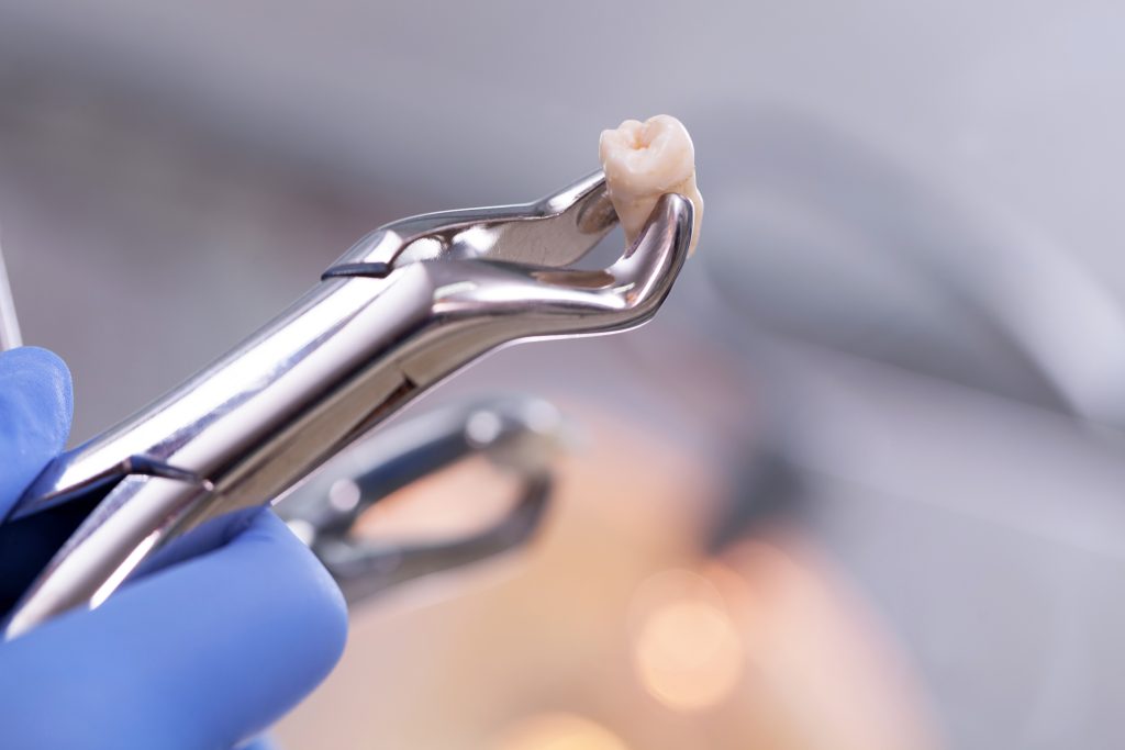When Would My Rapid City Dentist Perform A Tooth Extraction? 3 Rapid city dentist tooth extractions